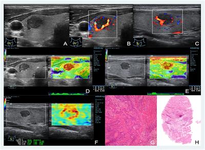 Diagnostic Performance of Multiple Sound Touch Elastography for Differentiating Benign and Malignant Thyroid Nodules